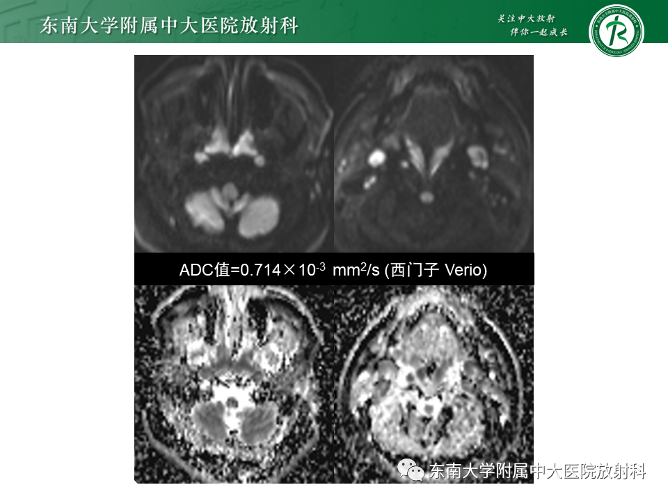 【PPT】鼻咽部占位性病变随访及鉴别-18