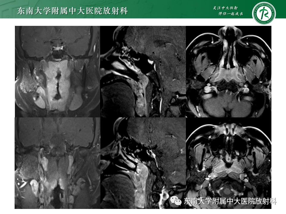 【PPT】鼻咽部占位性病变随访及鉴别-19