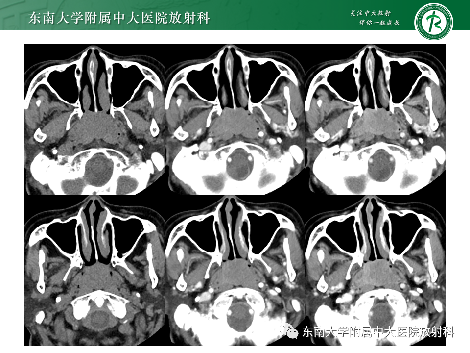 【PPT】鼻咽部占位性病变随访及鉴别-21