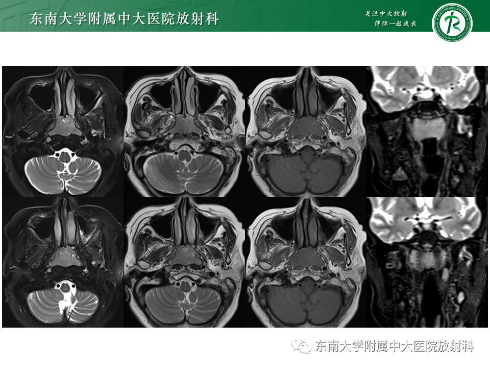 【PPT】鼻咽部占位性病变随访及鉴别-22