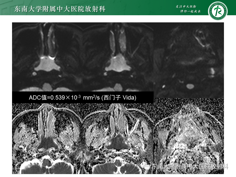 【PPT】鼻咽部占位性病变随访及鉴别-23