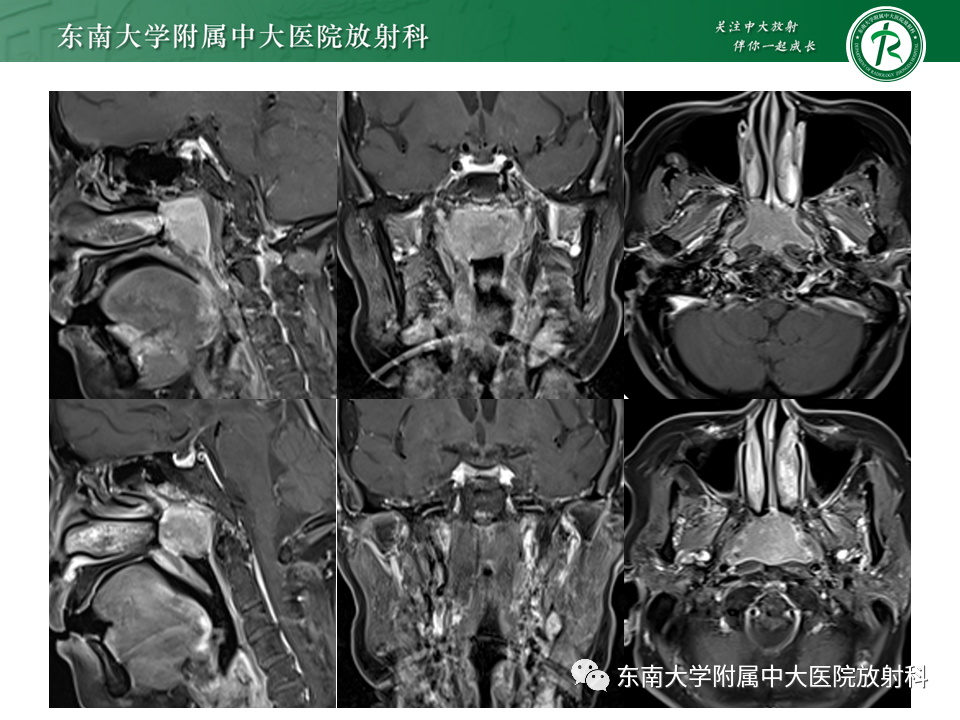 【PPT】鼻咽部占位性病变随访及鉴别-24