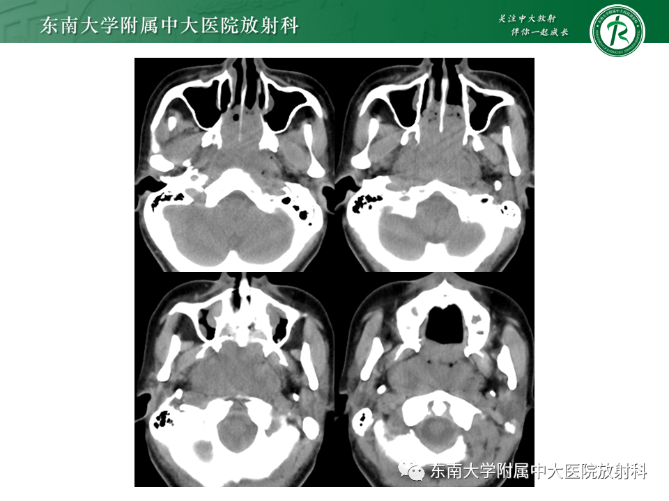 【PPT】鼻咽部占位性病变随访及鉴别-26