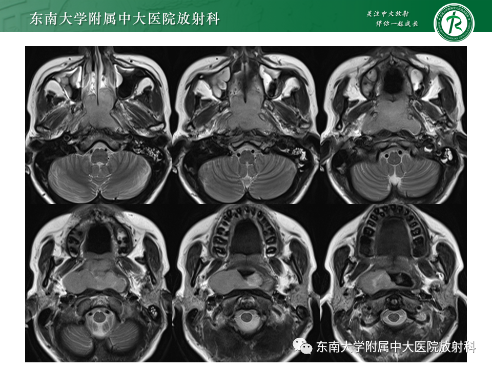 【PPT】鼻咽部占位性病变随访及鉴别-27