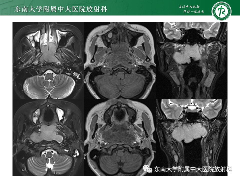 【PPT】鼻咽部占位性病变随访及鉴别-28