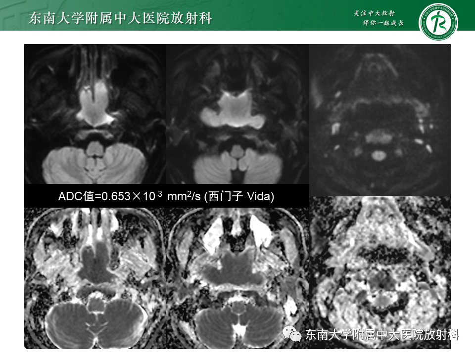 【PPT】鼻咽部占位性病变随访及鉴别-29