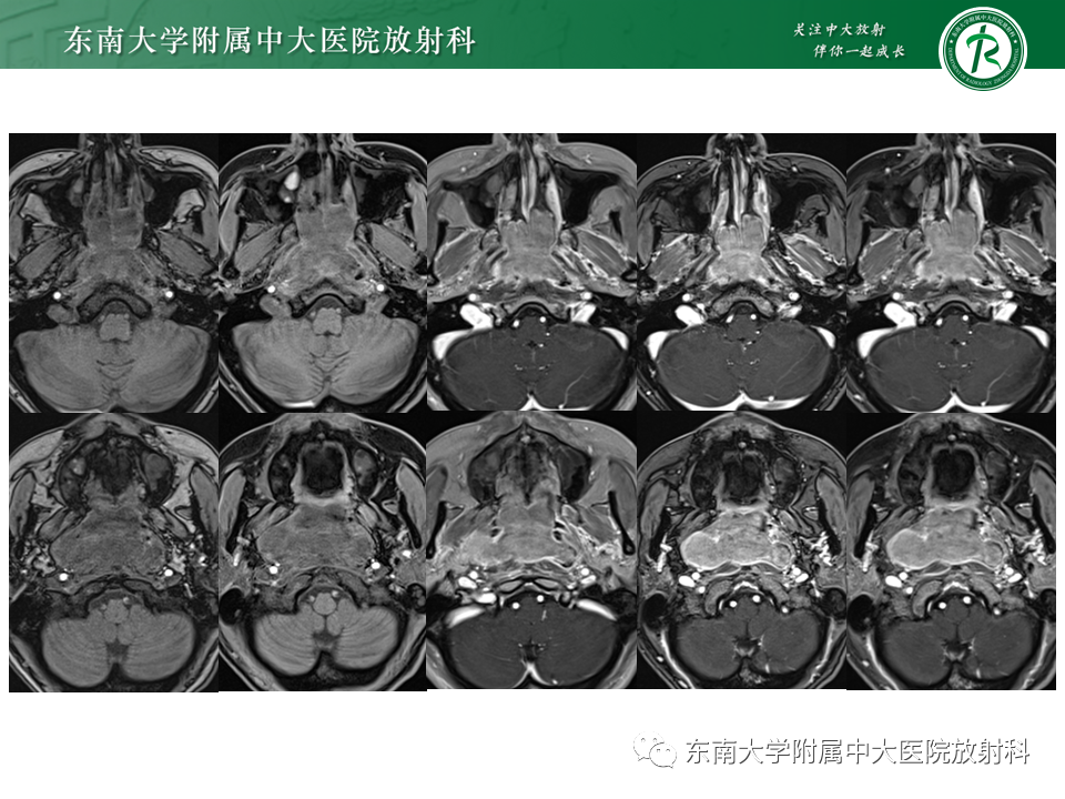 【PPT】鼻咽部占位性病变随访及鉴别-30