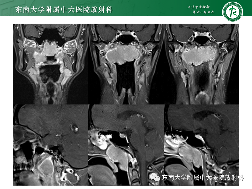 【PPT】鼻咽部占位性病变随访及鉴别-31