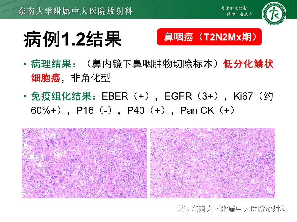 【PPT】鼻咽部占位性病变随访及鉴别-33