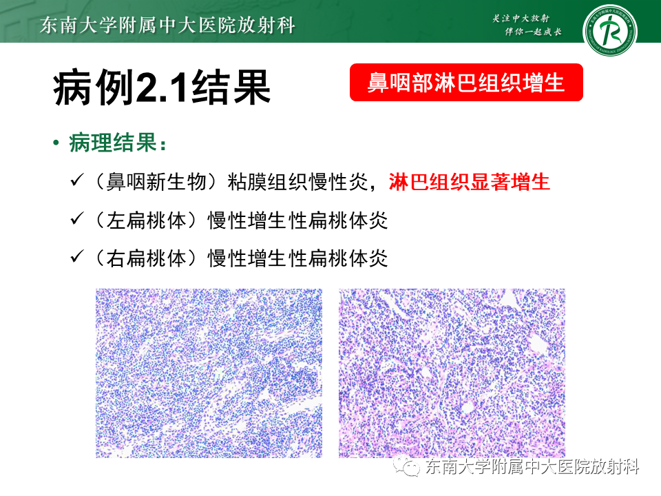 【PPT】鼻咽部占位性病变随访及鉴别-34