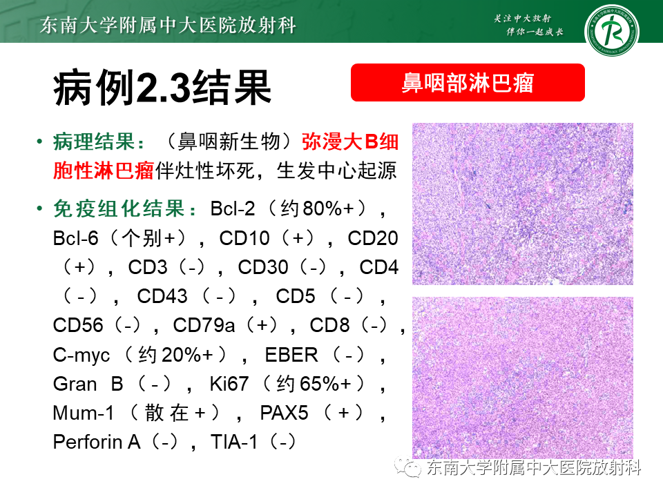 【PPT】鼻咽部占位性病变随访及鉴别-36