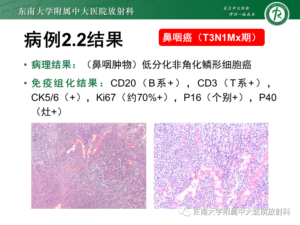 【PPT】鼻咽部占位性病变随访及鉴别-35