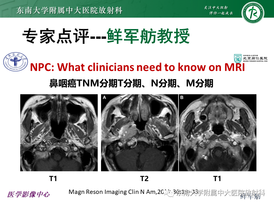 【PPT】鼻咽部占位性病变随访及鉴别-39