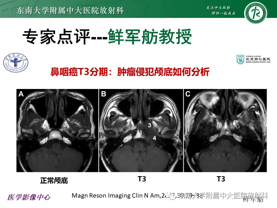 【PPT】鼻咽部占位性病变随访及鉴别-40