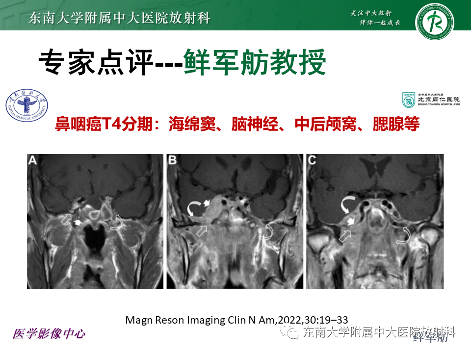 【PPT】鼻咽部占位性病变随访及鉴别-41