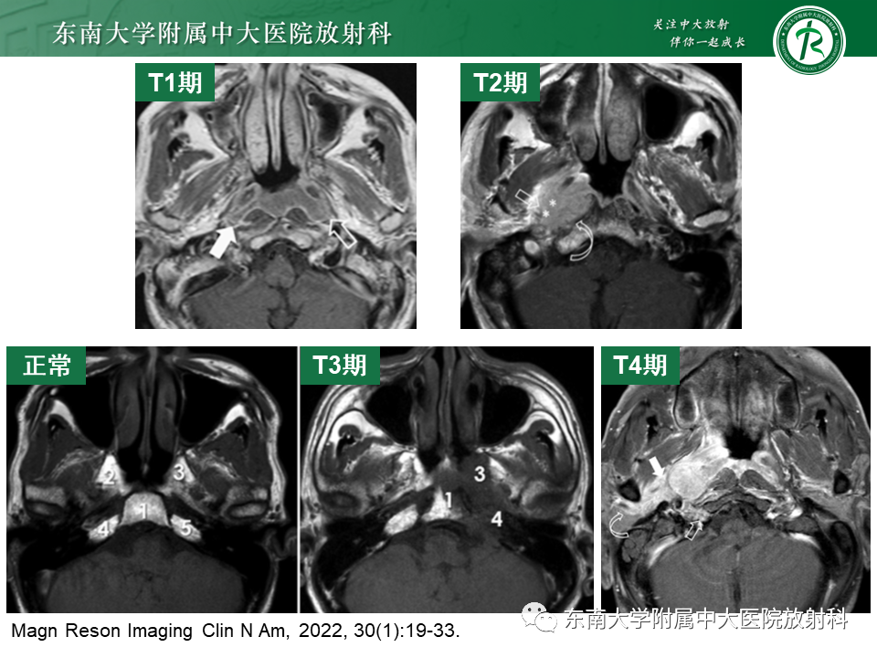 【PPT】鼻咽部占位性病变随访及鉴别-58