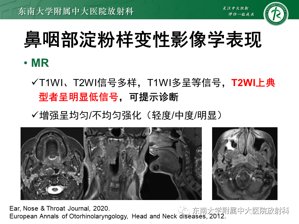 【PPT】鼻咽部占位性病变随访及鉴别-66