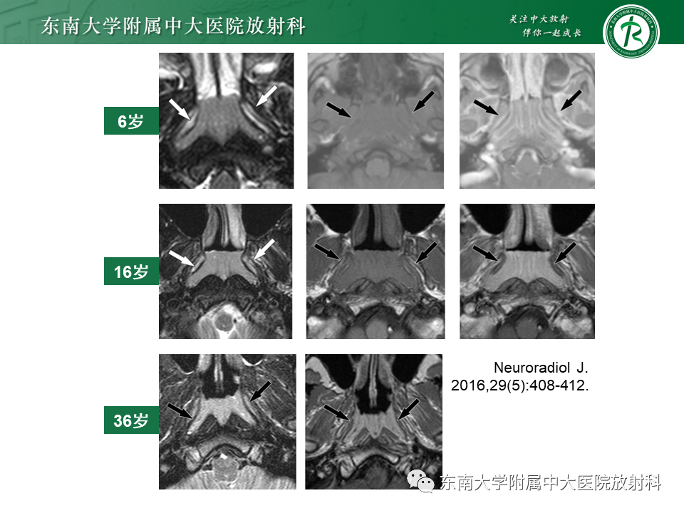 【PPT】鼻咽部占位性病变随访及鉴别-69