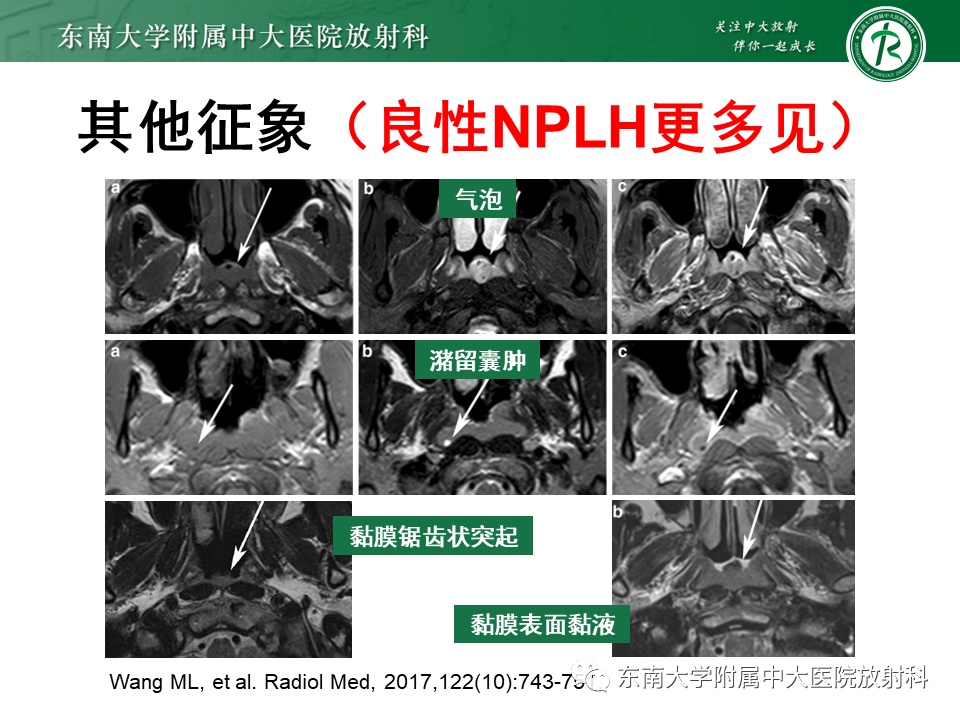 【PPT】鼻咽部占位性病变随访及鉴别-71