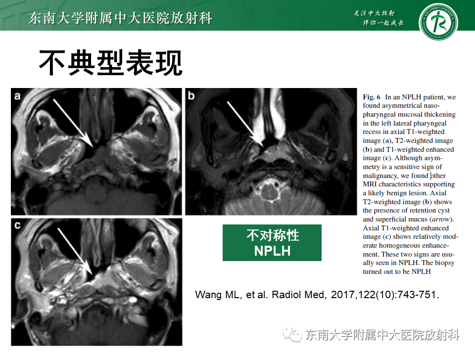 【PPT】鼻咽部占位性病变随访及鉴别-72