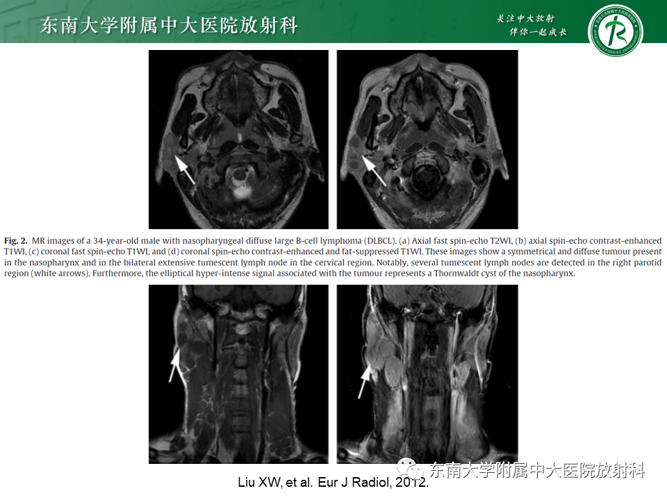 【PPT】鼻咽部占位性病变随访及鉴别-75