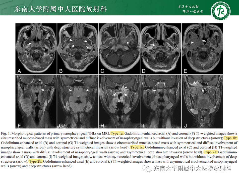 【PPT】鼻咽部占位性病变随访及鉴别-76