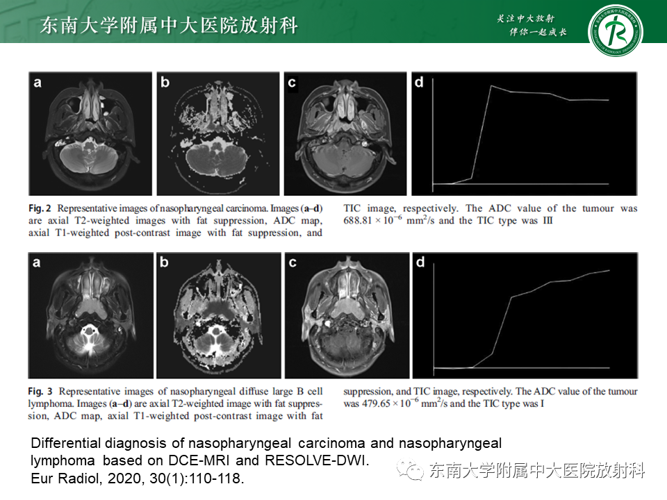 【PPT】鼻咽部占位性病变随访及鉴别-82