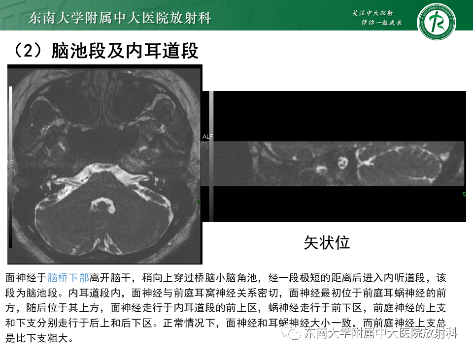 【PPT】面神经解剖及常见病影像学表现-15