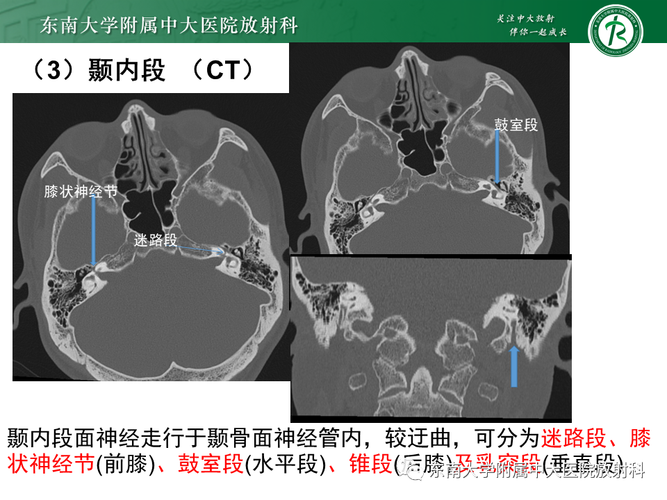 【PPT】面神经解剖及常见病影像学表现-16