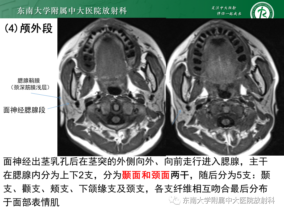 【PPT】面神经解剖及常见病影像学表现-18
