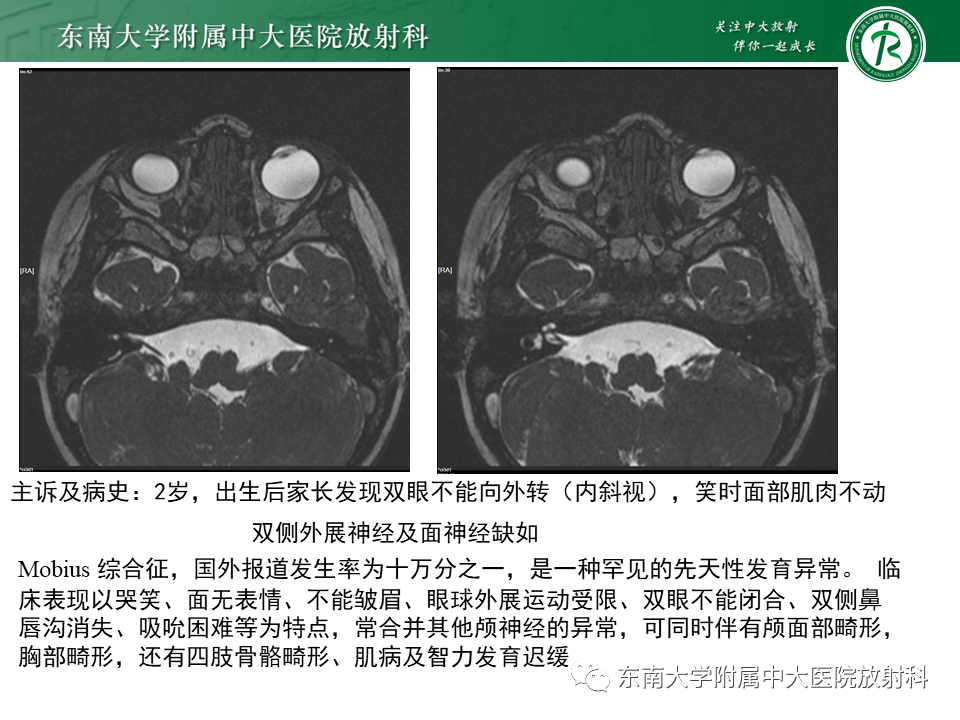 【PPT】面神经解剖及常见病影像学表现-21