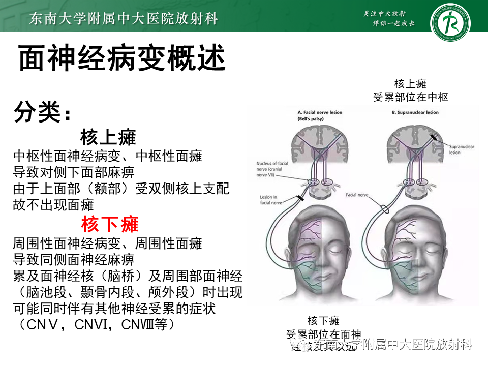 【PPT】面神经解剖及常见病影像学表现-22