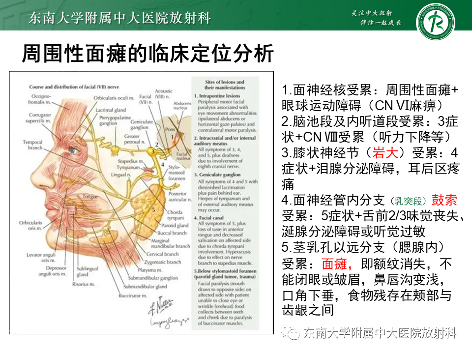 【PPT】面神经解剖及常见病影像学表现-23