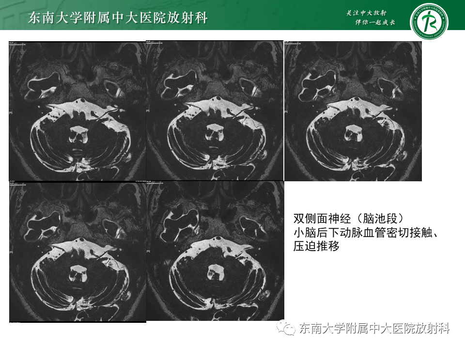 【PPT】面神经解剖及常见病影像学表现-26