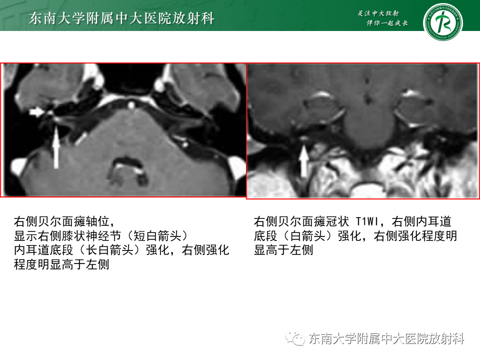 【PPT】面神经解剖及常见病影像学表现-28