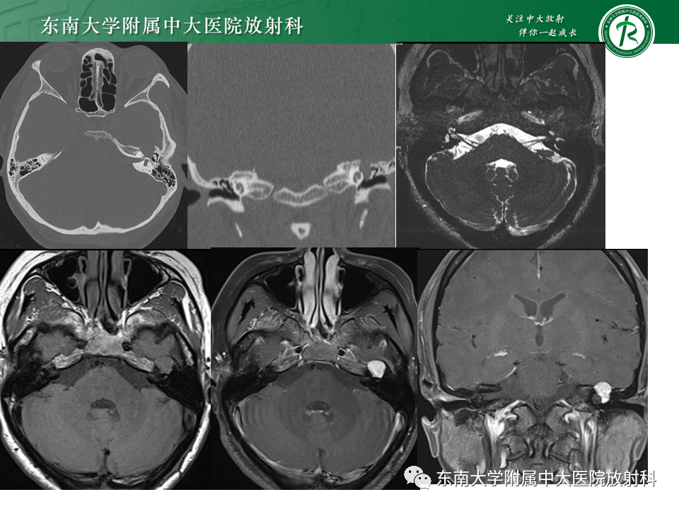 【PPT】面神经解剖及常见病影像学表现-32