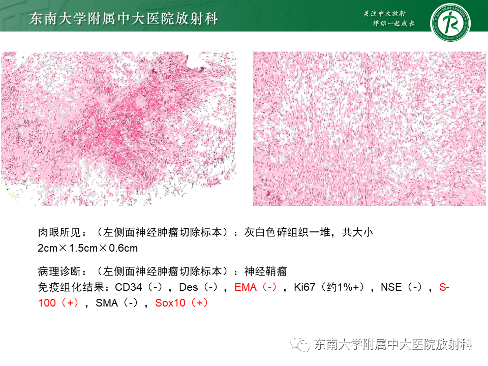 【PPT】面神经解剖及常见病影像学表现-35