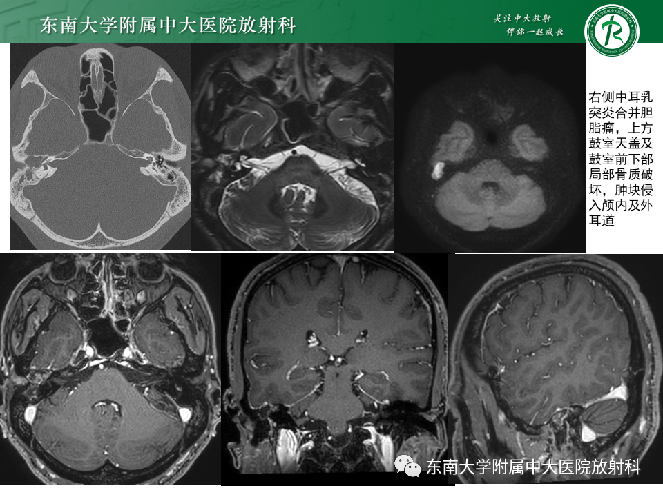 【PPT】面神经解剖及常见病影像学表现-37