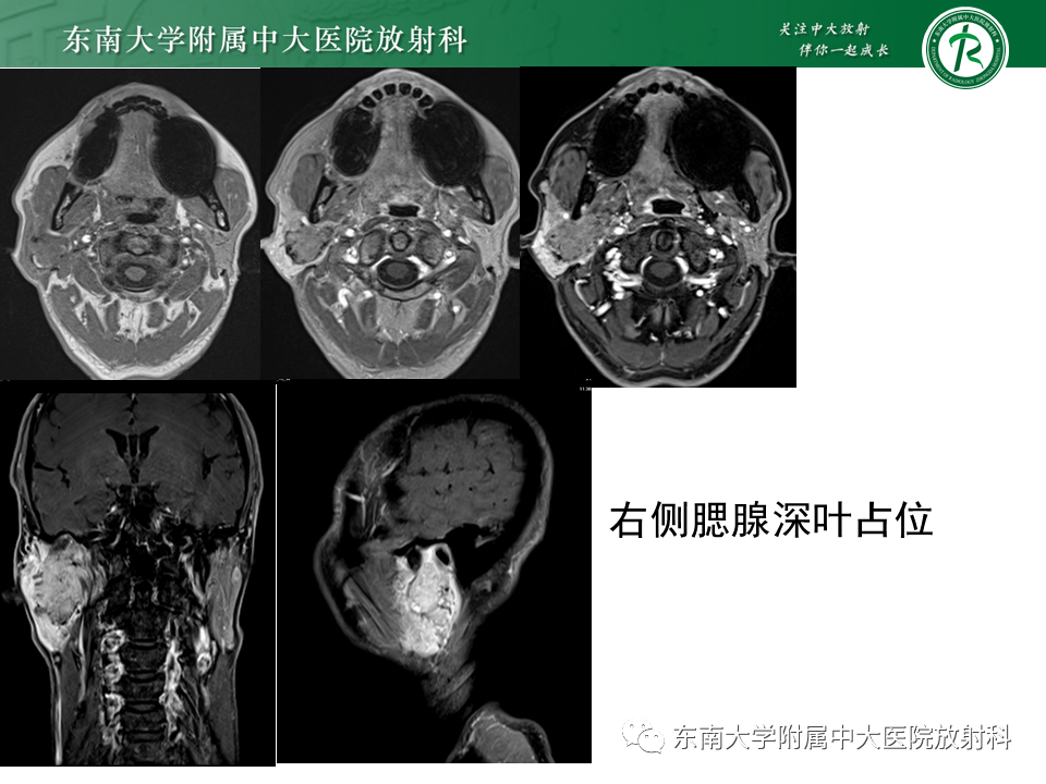 【PPT】面神经解剖及常见病影像学表现-46