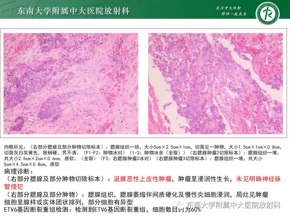 【PPT】面神经解剖及常见病影像学表现-48