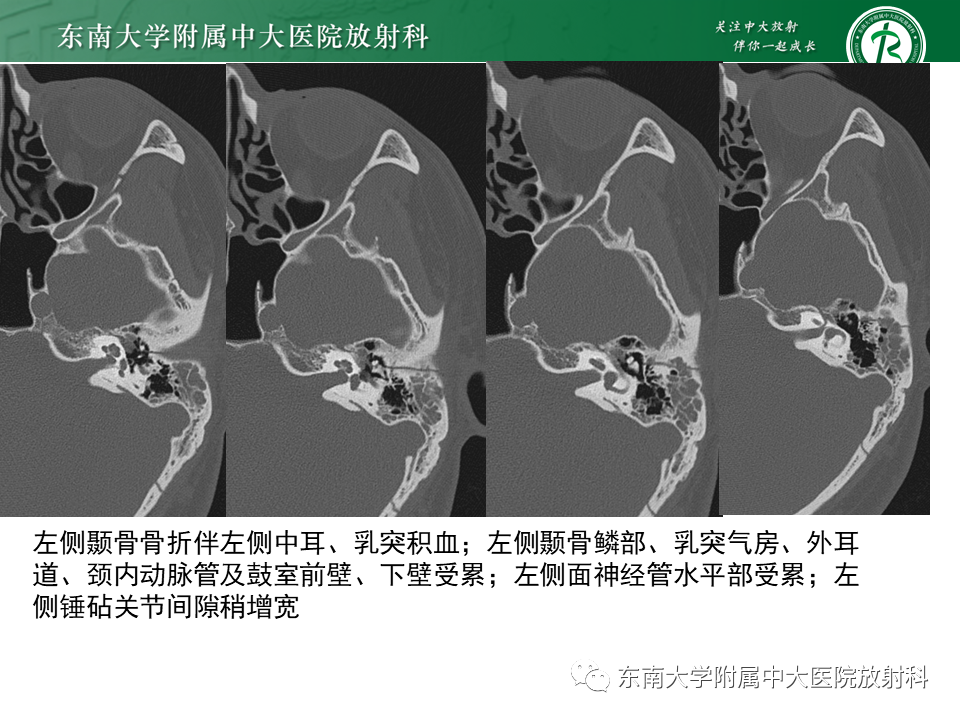 【PPT】面神经解剖及常见病影像学表现-51