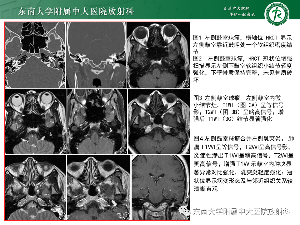 【PPT】面神经解剖及常见病影像学表现-42