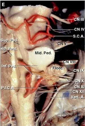 后颅窝三组神经血管复合体的记忆技巧-10