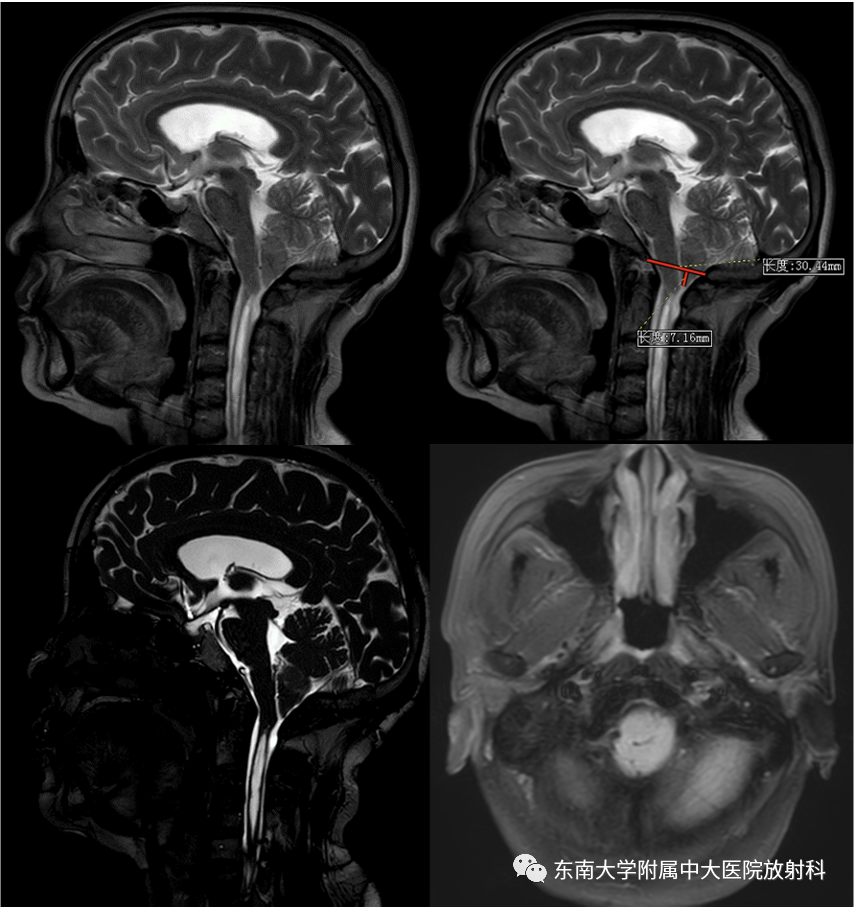 【PPT】小脑扁桃体下疝畸形-1