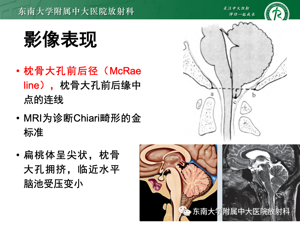【PPT】小脑扁桃体下疝畸形-10
