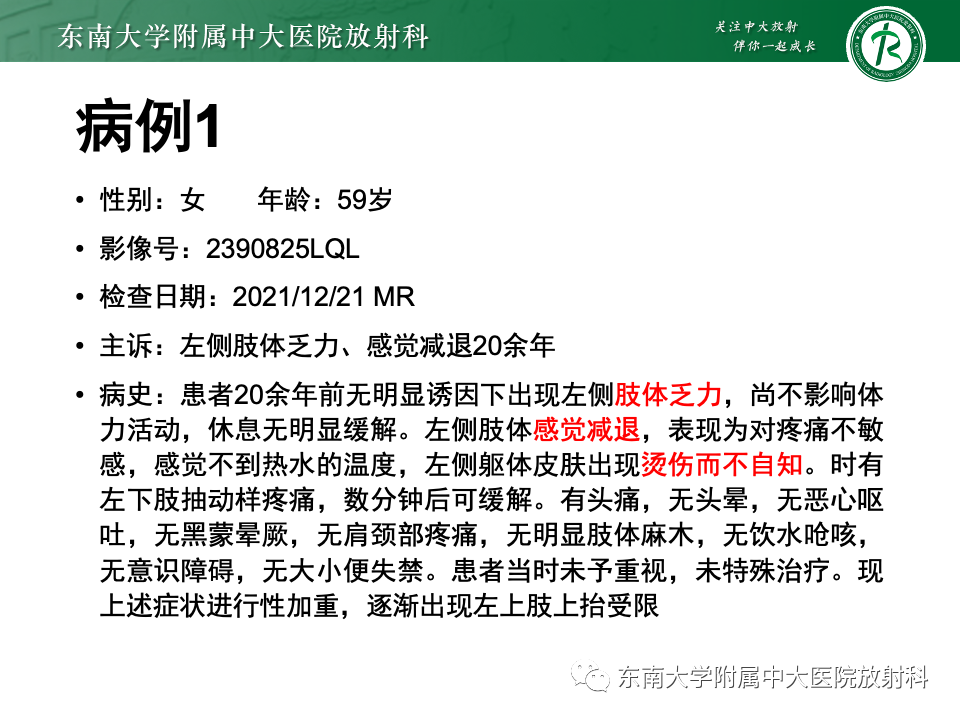 【PPT】小脑扁桃体下疝畸形-2