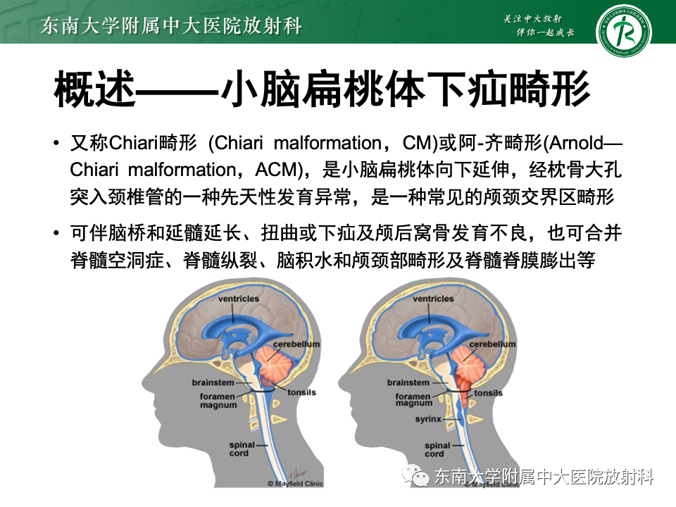 【PPT】小脑扁桃体下疝畸形-5