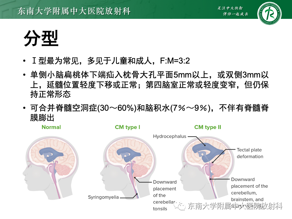 【PPT】小脑扁桃体下疝畸形-7