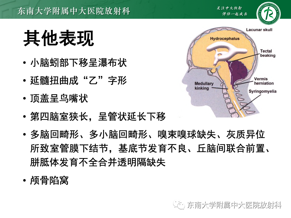 【PPT】小脑扁桃体下疝畸形-13