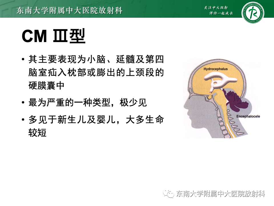 【PPT】小脑扁桃体下疝畸形-16